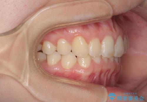 インビザラインによる前歯の矯正治療の治療後