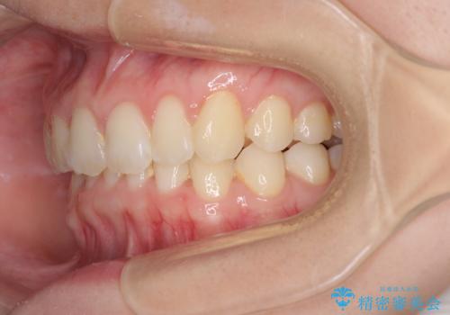 インビザラインによる前歯の矯正治療の治療後