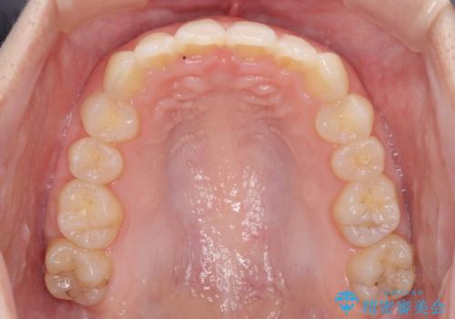 インビザラインによる前歯の矯正治療の治療後
