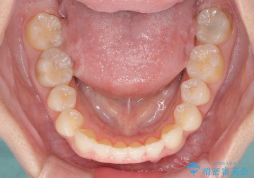 インビザラインによる前歯の矯正治療の治療後