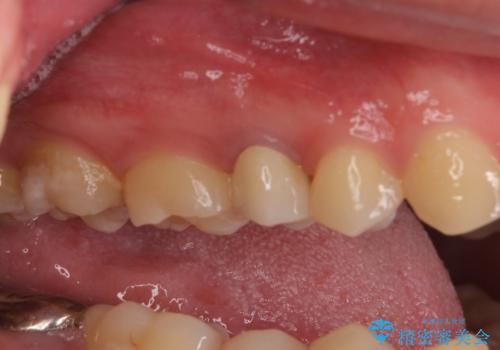 割れた歯を引っ張り出す　右上と左上の虫歯治療の治療後