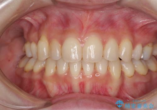 軽度な歯列不正　インビザライン・ライトによる矯正治療