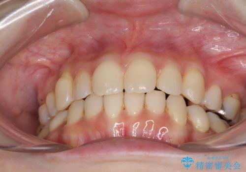 軽度な歯列不正 インビザライン・ライトによる矯正治療の治療後