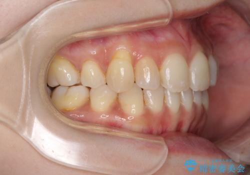 軽度な歯列不正 インビザライン・ライトによる矯正治療の治療後