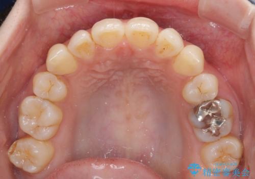 軽度な歯列不正 インビザライン・ライトによる矯正治療の治療後