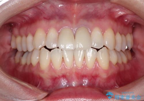 前歯の根元が黒い オールセラミッククラウンの装着による改善の治療後