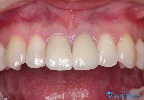 前歯の根元が黒い オールセラミッククラウンの装着による改善の治療後