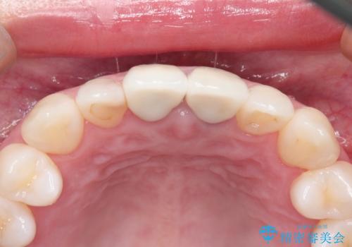 前歯の根元が黒い オールセラミッククラウンの装着による改善の治療後