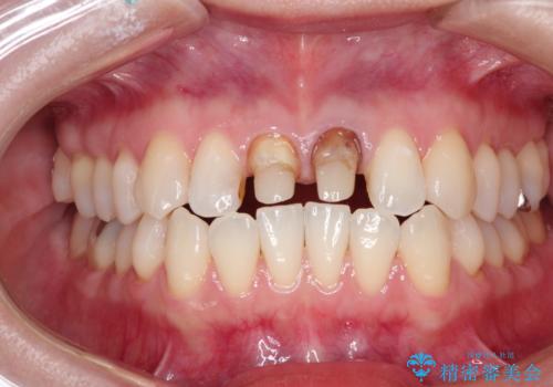 前歯の根元が黒い オールセラミッククラウンの装着による改善の治療中