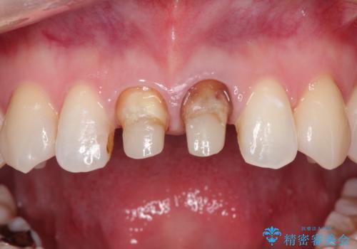 前歯の根元が黒い オールセラミッククラウンの装着による改善の治療中