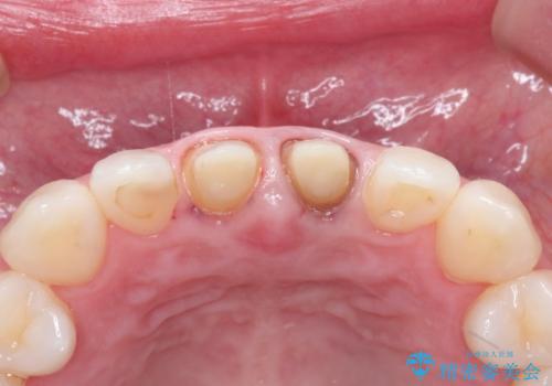 前歯の根元が黒い オールセラミッククラウンの装着による改善の治療中