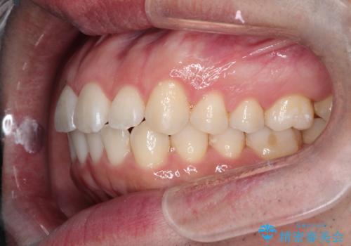インビザラインで前歯のがたつきを目立たずに矯正治療の治療後