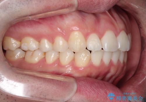 インビザラインで前歯のがたつきを目立たずに矯正治療の治療後