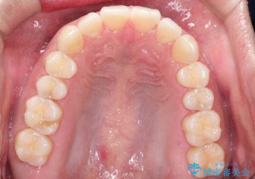 インビザラインで前歯のがたつきを目立たずに矯正治療の治療後