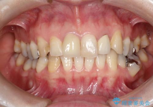 不自然な保険のかぶせ物をセラミックで自然な前歯への治療後