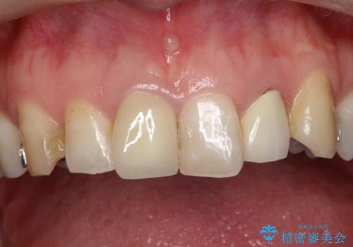 不自然な保険のかぶせ物をセラミックで自然な前歯への治療後