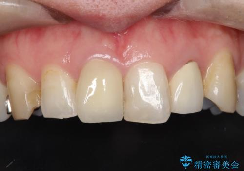 不自然な保険のかぶせ物をセラミックで自然な前歯への治療後