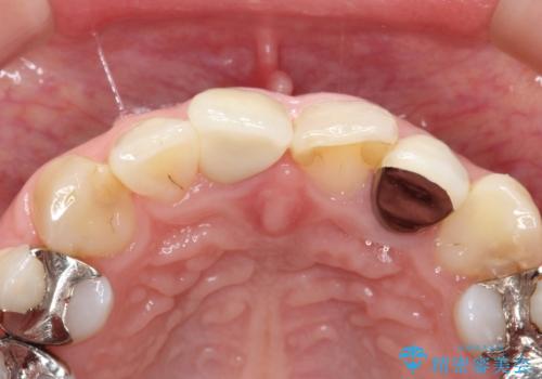 不自然な保険のかぶせ物をセラミックで自然な前歯への治療後