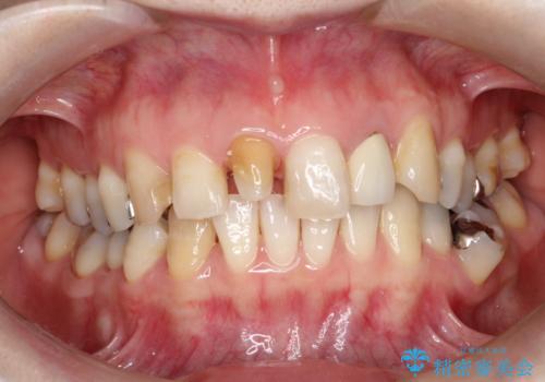 不自然な保険のかぶせ物をセラミックで自然な前歯への治療中