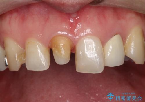 不自然な保険のかぶせ物をセラミックで自然な前歯への治療中