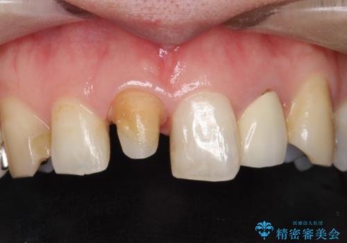 不自然な保険のかぶせ物をセラミックで自然な前歯への治療中