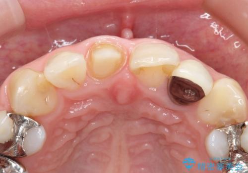 不自然な保険のかぶせ物をセラミックで自然な前歯への治療中