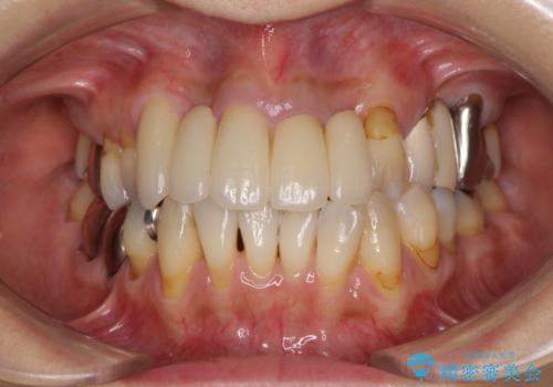 空気が抜けて話しにくい前歯のブリッジの作り直し オールセラミックブリッジにて審美的に仕上げるの治療後