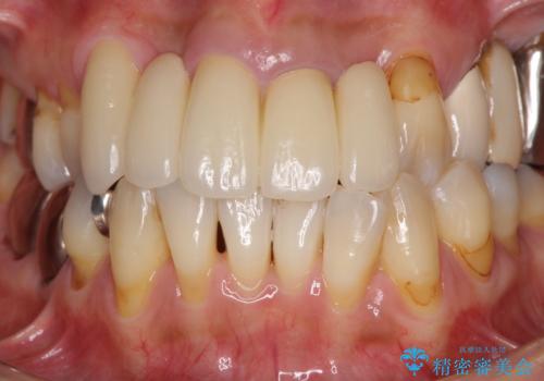 空気が抜けて話しにくい前歯のブリッジの作り直し オールセラミックブリッジにて審美的に仕上げるの治療後