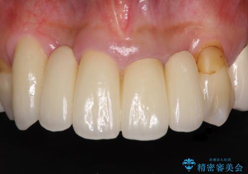 空気が抜けて話しにくい前歯のブリッジの作り直し オールセラミックブリッジにて審美的に仕上げる