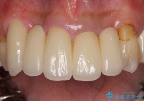 空気が抜けて話しにくい前歯のブリッジの作り直し オールセラミックブリッジにて審美的に仕上げるの治療後