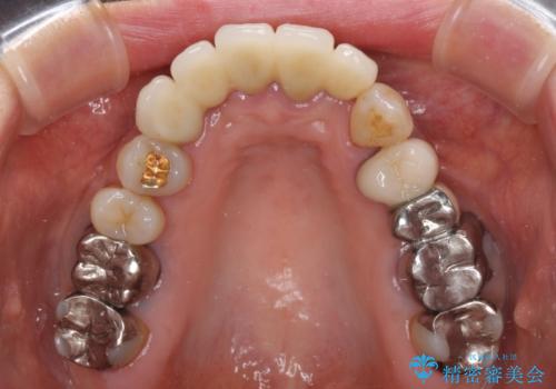 空気が抜けて話しにくい前歯のブリッジの作り直し オールセラミックブリッジにて審美的に仕上げるの治療後