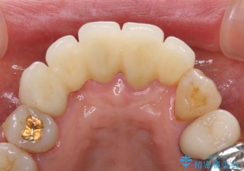 空気が抜けて話しにくい前歯のブリッジの作り直し オールセラミックブリッジにて審美的に仕上げるの治療後