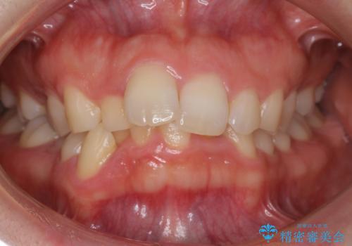 抜かない矯正　前歯がとび出ているのをマウスピースでの症例 治療前