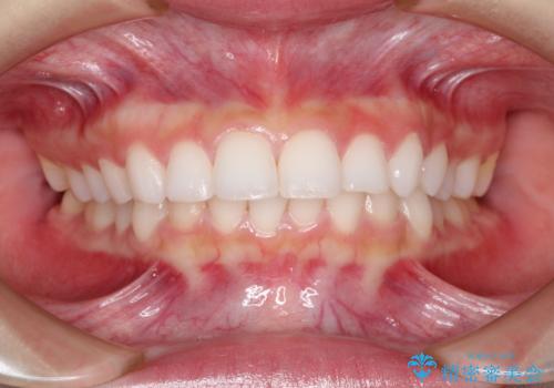 出っ歯の矯正治療 歯を抜かずにインビザラインでの治療前