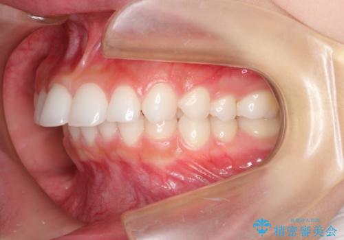 出っ歯の矯正治療 歯を抜かずにインビザラインでの治療前