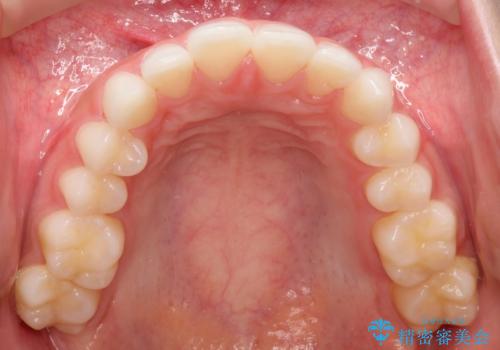 出っ歯の矯正治療 歯を抜かずにインビザラインでの治療前