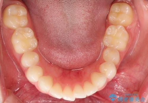 出っ歯の矯正治療 歯を抜かずにインビザラインでの治療前