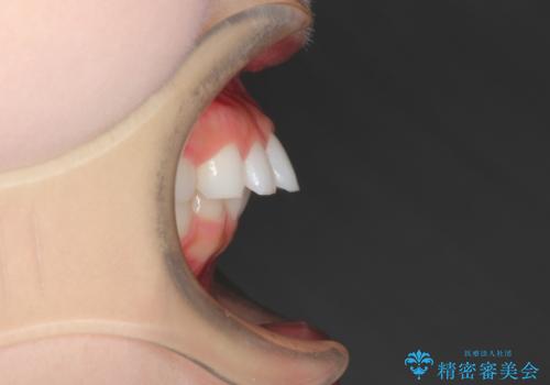 出っ歯の矯正治療 歯を抜かずにインビザラインで