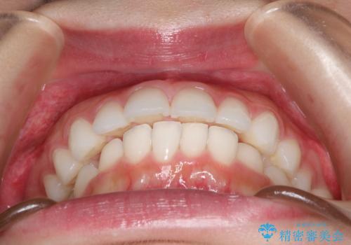 出っ歯の矯正治療　歯を抜かずにインビザラインでの治療前