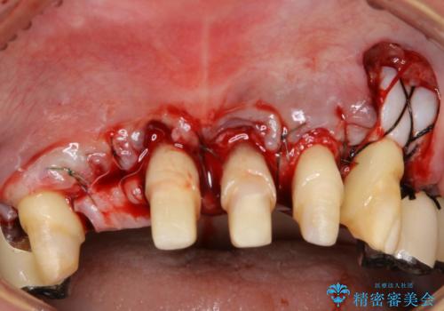 歯周病におかされた前歯の再建治療の治療中