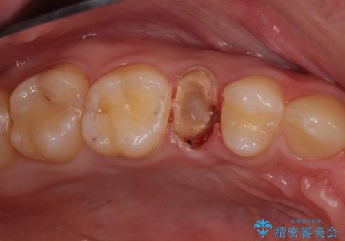 割れた歯を引っ張り出す　右上と左上の虫歯治療の治療前