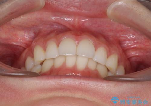 矯正治療の後戻りをインビザライン・ライトで改善の治療前