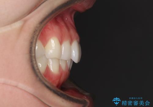 矯正治療の後戻りをインビザライン・ライトで改善の治療前