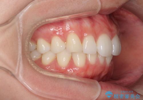矯正治療の後戻りをインビザライン・ライトで改善の治療前