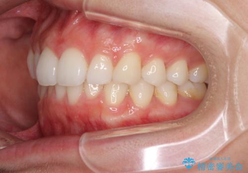 矯正治療の後戻りをインビザライン・ライトで改善の治療前