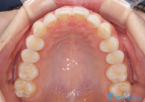 矯正治療の後戻りをインビザライン・ライトで改善の治療前