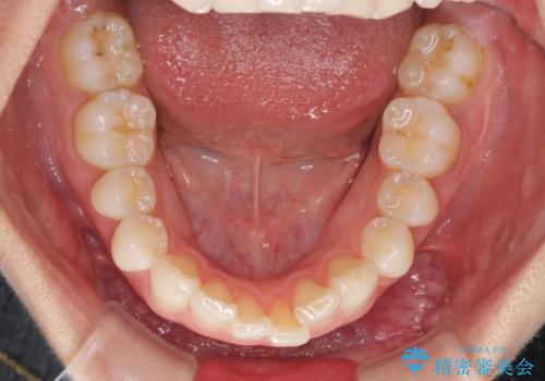 矯正治療の後戻りをインビザライン・ライトで改善の治療前