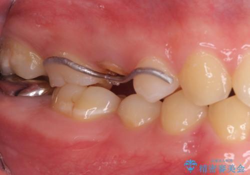 割れた歯を引っ張り出す　右上と左上の虫歯治療の治療中