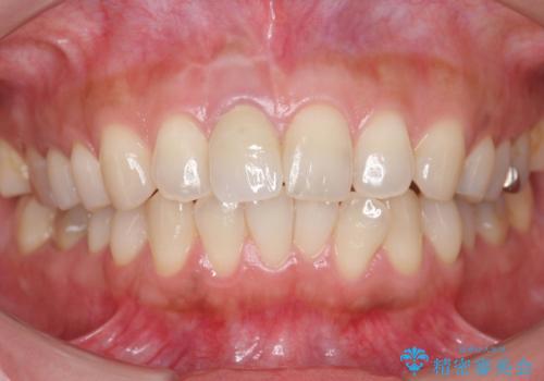 差し歯をもっと自然に 30代女性の治療後