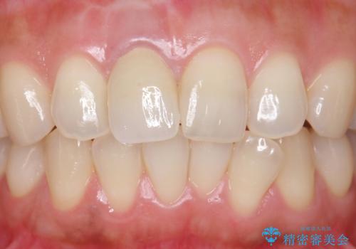 差し歯をもっと自然に 30代女性の治療後